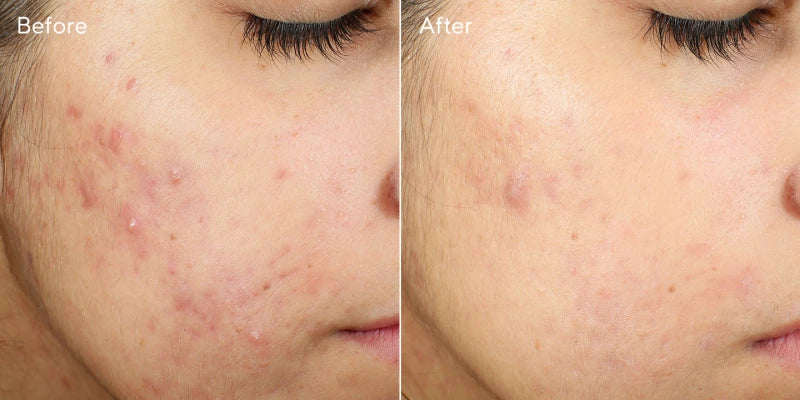 Murad - InvisiScar resurfacing Treatment - Effectief Pokdalige littekens - Acne littekens - Beauty Junkies