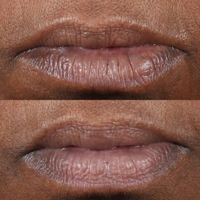 Perricone MD - Cold Plasma Plus+ Lip Therapy