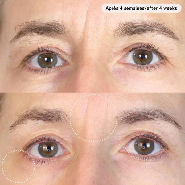 Voor- en nafoto van fronsrimpels na 4 weken met Le Masque du Temps
