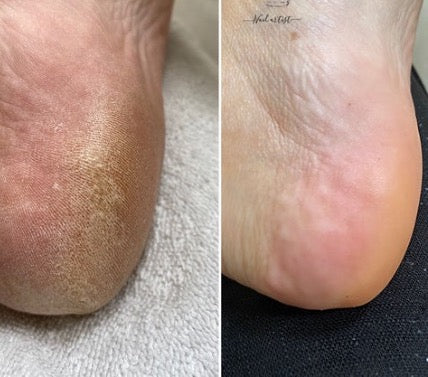 Lova Skin - Instant Foot Peeling Spray - Beauty Junkies