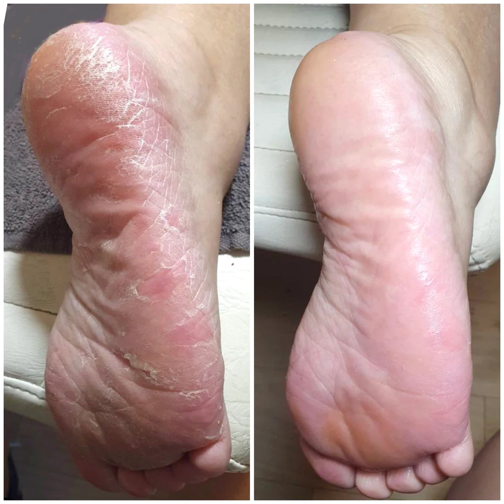 Lova Skin - Instant Foot Peeling - Beauty Junkies Store