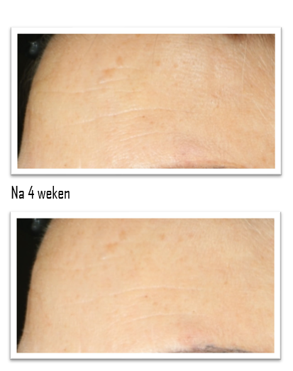 Murad - Retinol Youth Renewal Night Cream - Nachtcrème - Hormonale huid - Beauty Junkies