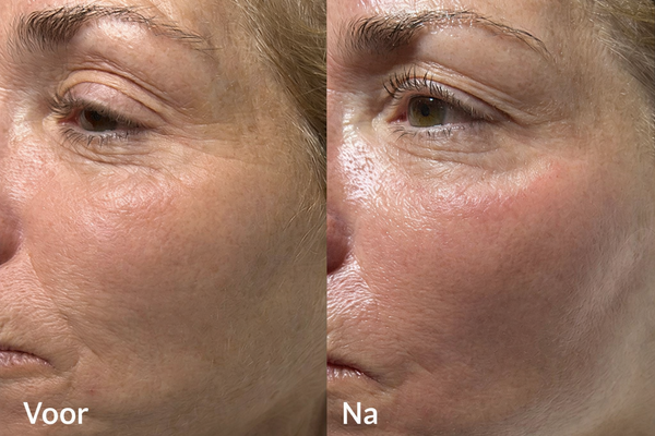 Signature HydraFacial