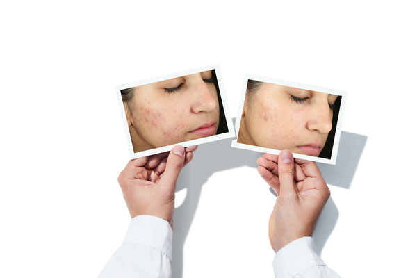 Murad - InvisiScar resurfacing Treatment - Effectief Pokdalige littekens - Acne littekens - Beauty Junkies